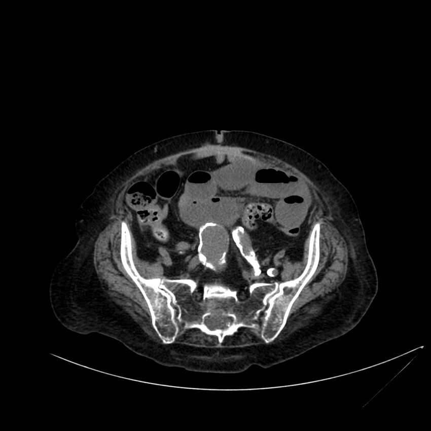 Abdominal aortic aneurysm - impending rupture (Radiopaedia 19233-19246 Axial non-contrast 94).jpg