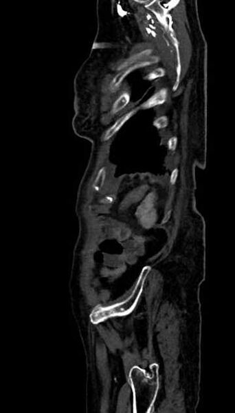 File:Abdominal aortic aneurysm with thrombus fissuration (Radiopaedia 73192-83919 Sagittal C+ arterial phase 8).jpg