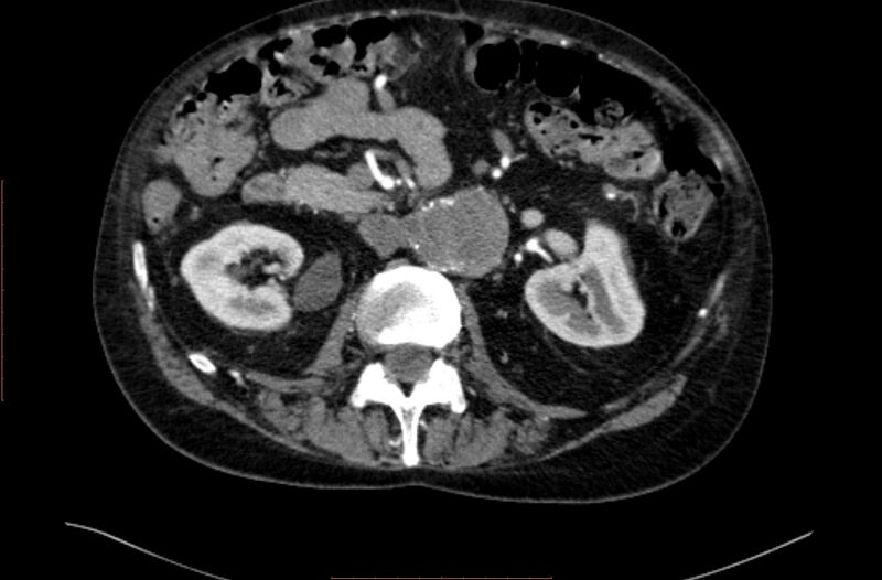 File:Abdominal aortic interposition tube graft and aneurysm thrombosis (Radiopaedia 71438-81857 Axial C+ arterial phase 58).jpg
