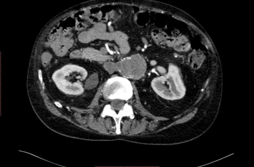 Abdominal aortic interposition tube graft and aneurysm thrombosis (Radiopaedia 71438-81857 Axial C+ arterial phase 58).jpg