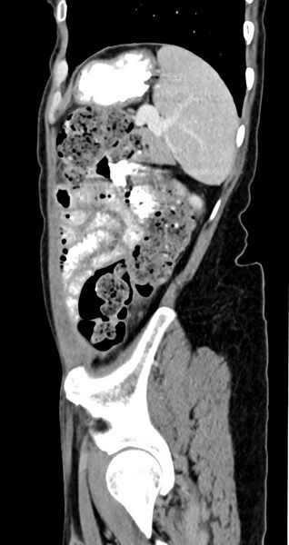 File:Abdominal wall and retroperitoneal tuberculosis (Radiopaedia 88137-104729 Sagittal C+ portal venous phase 34).jpg