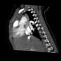 Aberrant left pulmonary artery (pulmonary sling) (Radiopaedia 42323-45435 Sagittal C+ arterial phase 21).jpg