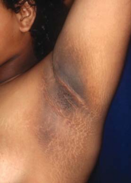 File:Acanthosis nigricans.png