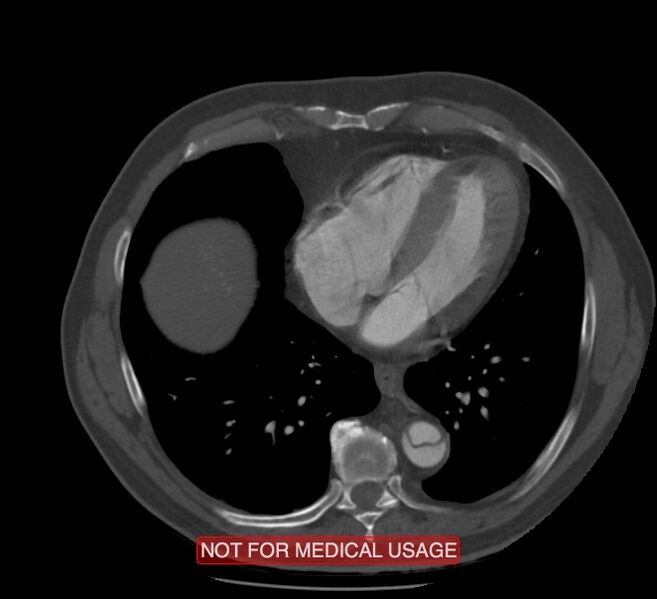 File:Acute aortic dissection - Stanford type A (Radiopaedia 40661-43285 Axial C+ arterial phase 49).jpg