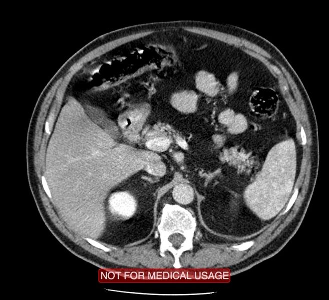 File:Acute aortic dissection - Stanford type A (Radiopaedia 40661-43285 Axial C+ portal venous phase 83).jpg