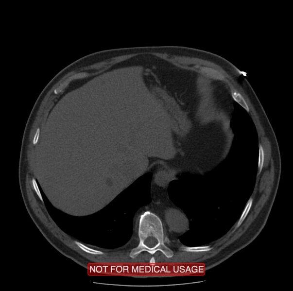 File:Acute aortic dissection - Stanford type A (Radiopaedia 40661-43285 Axial non-contrast 62).jpg