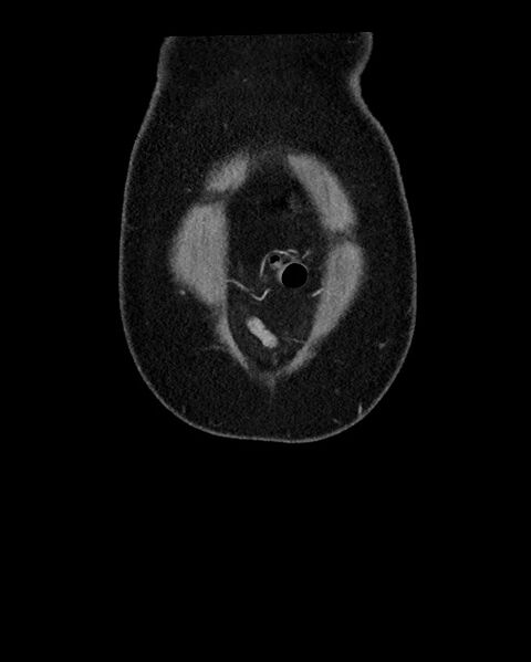 File:Acute appendicitis - large appendicoliths (Radiopaedia 61805-69820 Coronal C+ portal venous phase 13).jpg