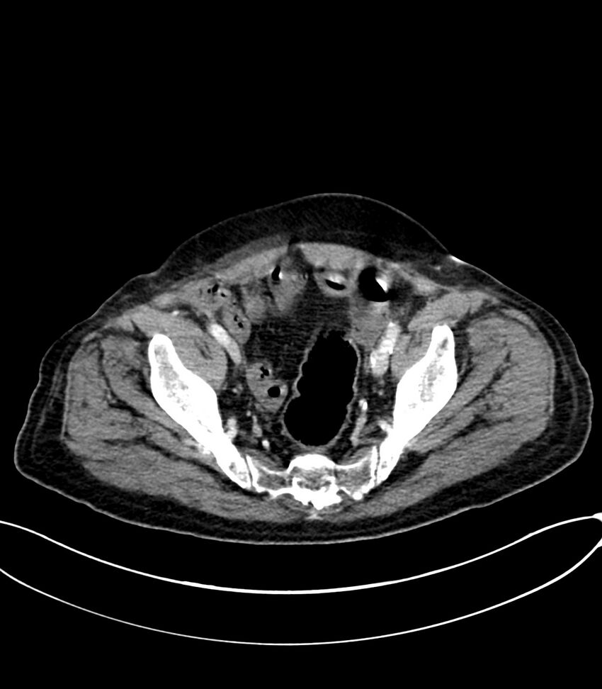 Acute arterial mesenteric ischemia (Radiopaedia 78238-90828 Axial C+ portal venous phase 121).jpg