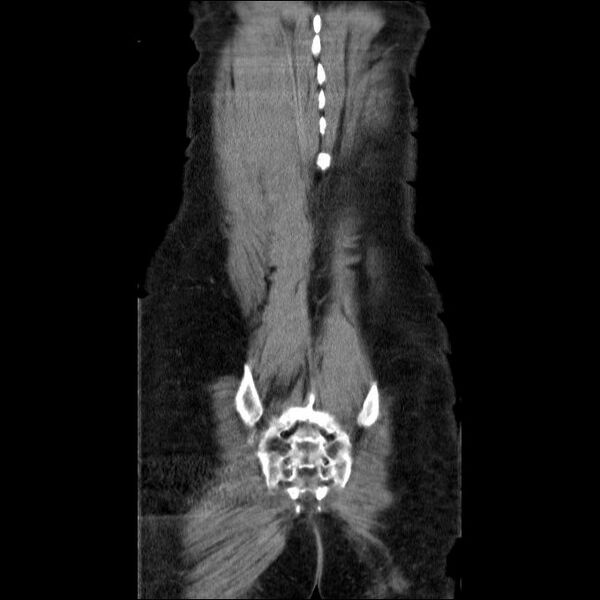File:Acute cholecystitis and incidental left sided IVC (Radiopaedia 49352-54459 Coronal C+ portal venous phase 9).jpg