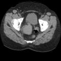 Acute cholecystitis and ureteric colic (Radiopaedia 42330-45444 Axial prone 101).jpg