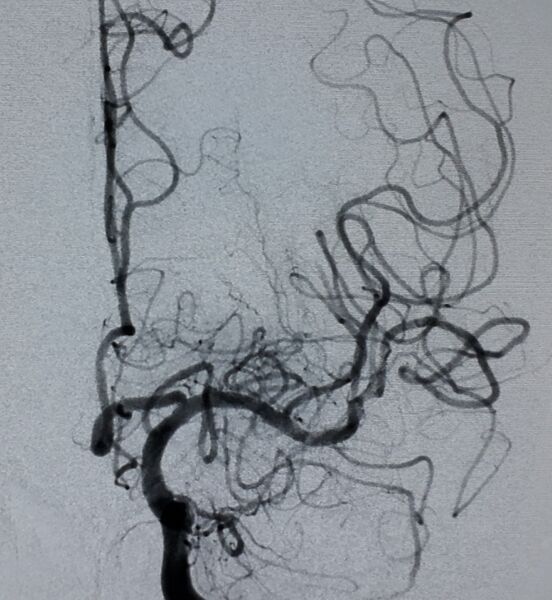 File:Acute left ICA and M1 occlusion treated with mechanical thrombectomy (Radiopaedia 56085-62813 E 1).jpg