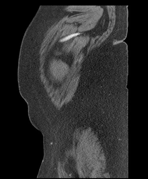 File:Acute mesenteric venous ischemia (Radiopaedia 46041-50383 Sagittal C+ portal venous phase 5).jpg