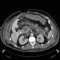 Acute pancreatic necrosis (Radiopaedia 13560-18503 Axial C+ portal venous phase 29).jpg