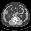 Acute pancreatitis - mild (Radiopaedia 27796-28033 Axial non-contrast 29).jpg