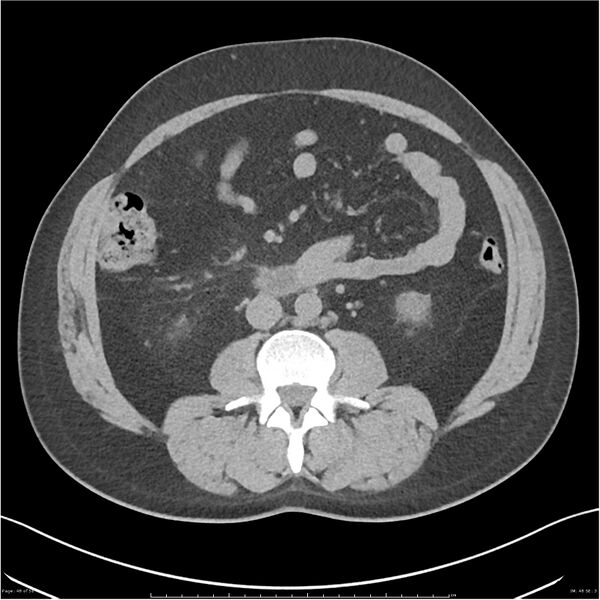 File:Acute pancreatitis - mild (Radiopaedia 27796-28033 Axial non-contrast 29).jpg