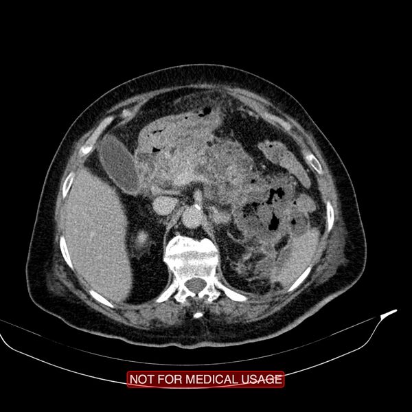 File:Acute pancreatitis with infected necrosis (Radiopaedia 26454-26585 Axial C+ delayed 11).jpg