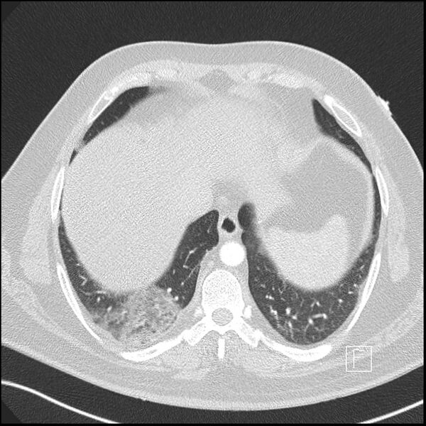 File:Acute pulmonary embolism with pulmonary infarct (Radiopaedia 73062-83768 Axial lung window 18).jpg