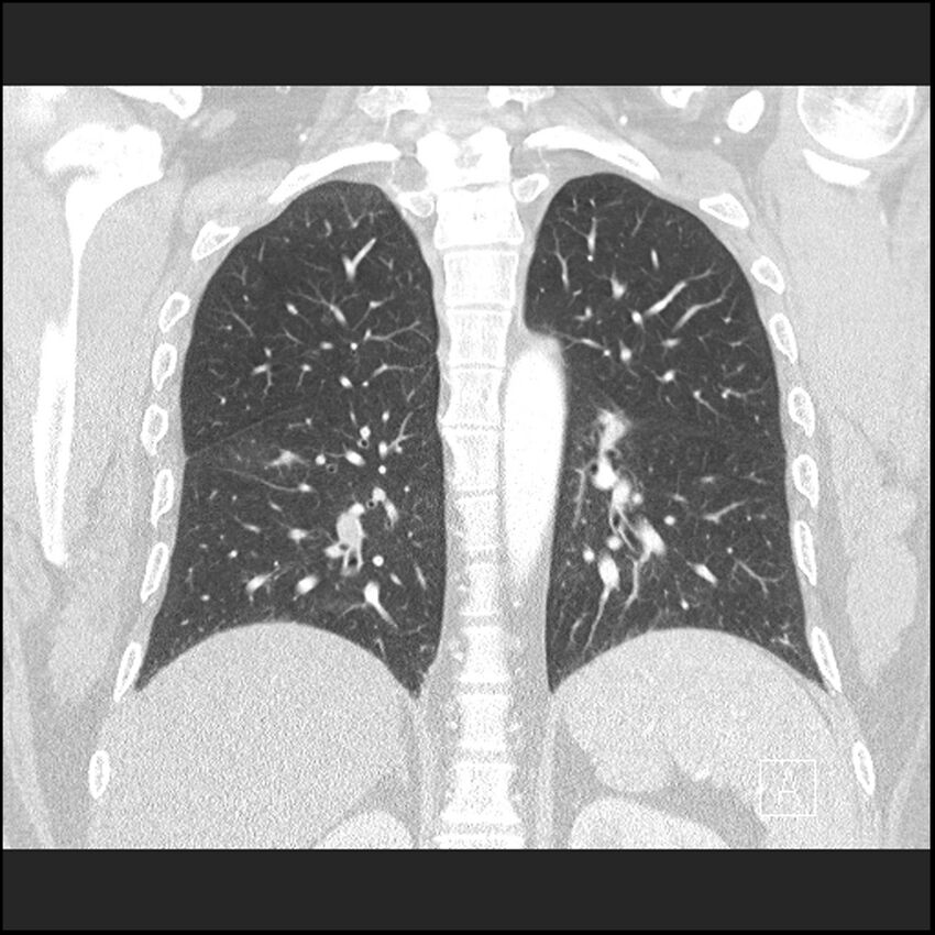 Acute pulmonary embolism with pulmonary infarct (Radiopaedia 73062-83768 Coronal lung window 51).jpg