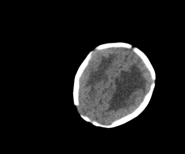 File:Acute ventriculitis (Radiopaedia 57502-64459 Axial non-contrast 17).jpg