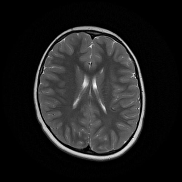 File:Adamantinomatous craniopharyngioma (Radiopaedia 77407-89529 Axial T2 16).jpg