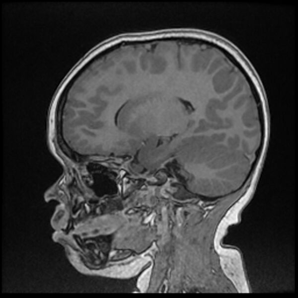 File:Adamantinomatous craniopharyngioma (Radiopaedia 77407-89529 Sagittal T1 C+ 51).jpg