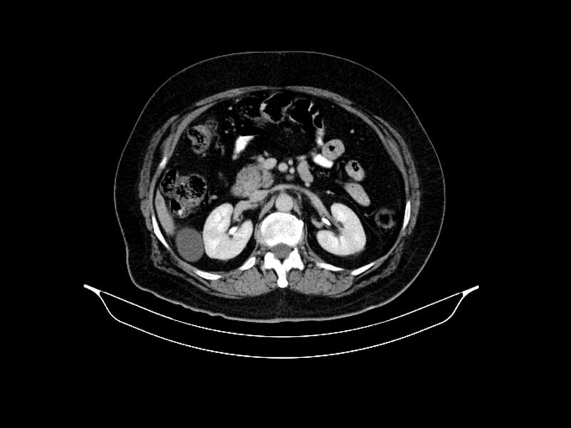 File:Adenocarcinoma of pancreas with hepatic metastasis (Radiopaedia 64332-73122 Axial C+ delayed 40).jpg