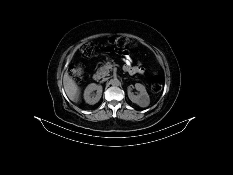 File:Adenocarcinoma of pancreas with hepatic metastasis (Radiopaedia 64332-73122 Axial non-contrast 39).jpg