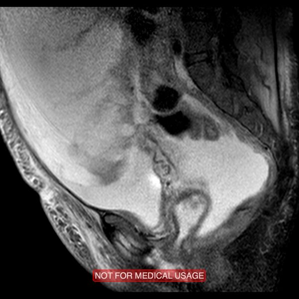 File:Adenocarcinoma of the cervix (Radiopaedia 28373-28615 Sagittal T2 fat sat 6).jpg