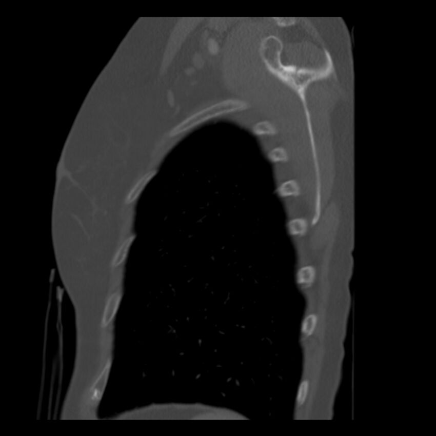 Adenocarcinoma of the lung (Radiopaedia 41015-43755 Sagittal bone window 98).jpg