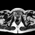 Adenomyoma of the uterus (huge) (Radiopaedia 9870-10438 Axial T2 7).jpg