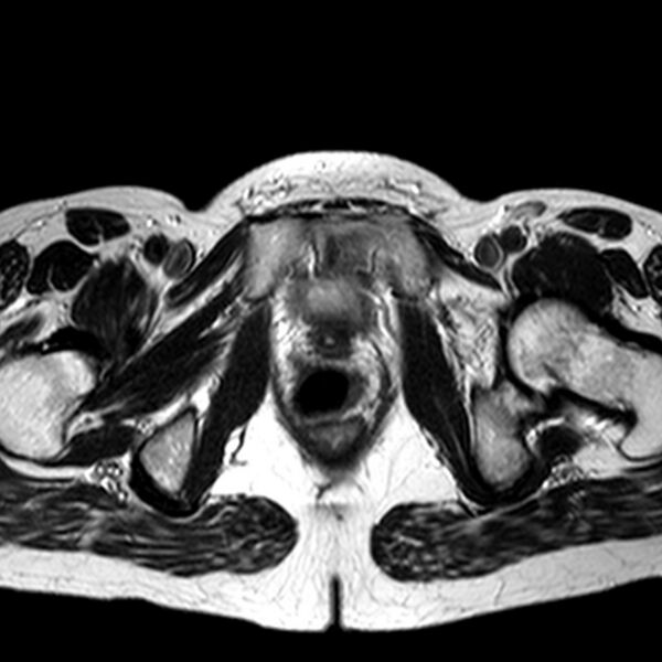 File:Adenomyoma of the uterus (huge) (Radiopaedia 9870-10438 Axial T2 7).jpg