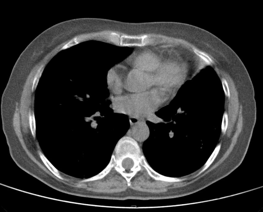 Adenosquamous lung carcinoma (Radiopaedia 22035-22030 non-contrast 36).jpg
