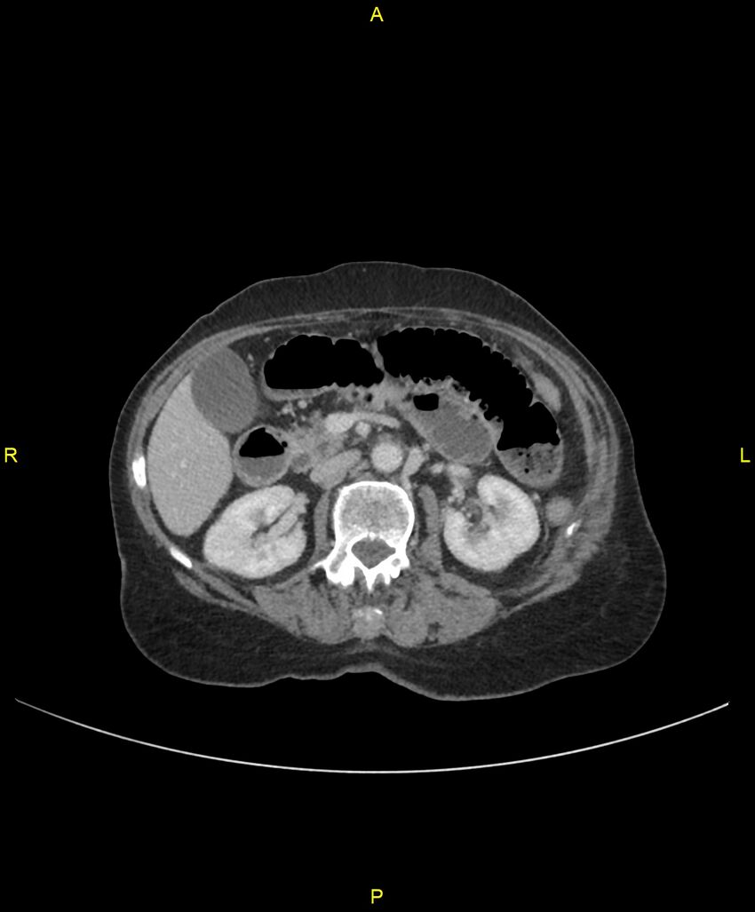 Adhesional small bowel obstruction (Radiopaedia 85402-101024 Axial C+ portal venous phase 112).jpg