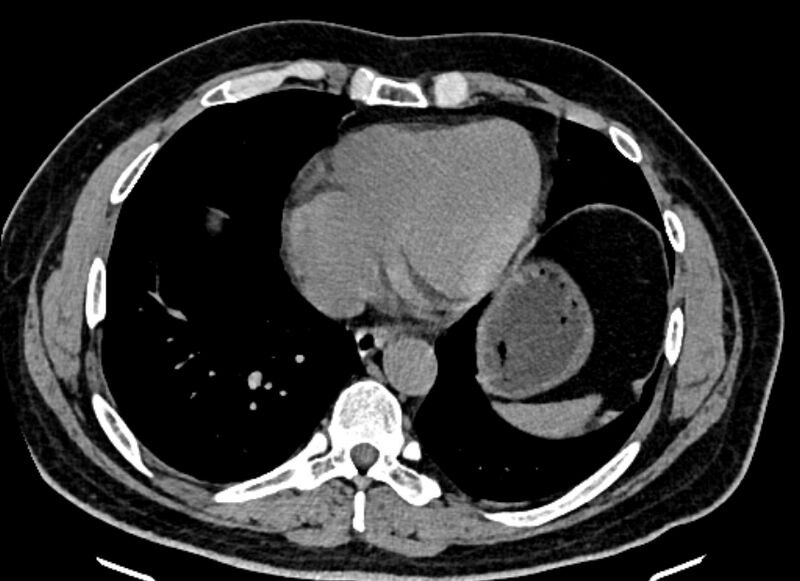 File:Adrenal metastases (Radiopaedia 73082-83791 Axial non-contrast 7).jpg