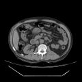 Adrenal myelolipoma (Radiopaedia 41843-44834 Axial non-contrast 34).jpg