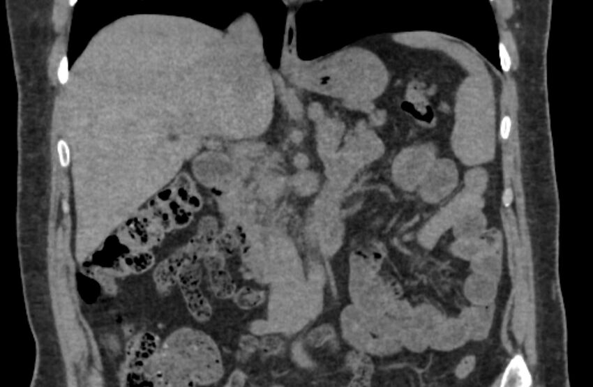 Adrenal myelolipoma (Radiopaedia 65240-74253 Coronal non-contrast 8).jpg
