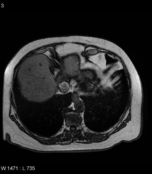File:Adrenal myelolipoma (Radiopaedia 6765-7961 Axial T1 out-of-phase 3).jpg