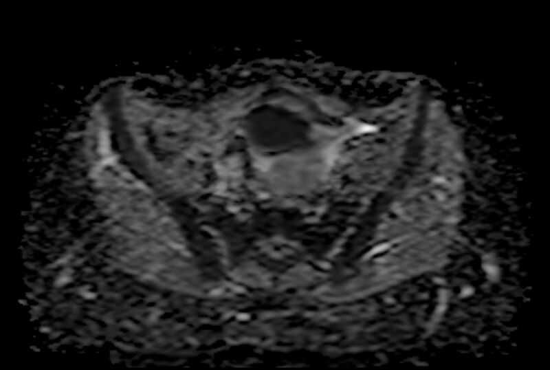 File:Adult granulosa cell tumor of the ovary (Radiopaedia 71581-81950 Axial ADC 10).jpg
