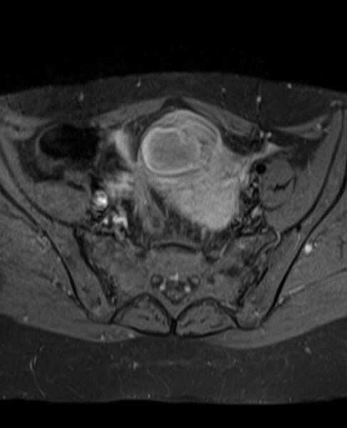 File:Adult granulosa cell tumor of the ovary (Radiopaedia 71581-81950 Axial T1 C+ fat sat 10).jpg