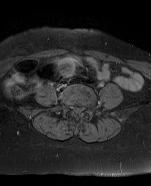 File:Adult granulosa cell tumor of the ovary (Radiopaedia 71581-81950 Axial T1 C+ fat sat 2).jpg