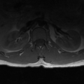 Aggressive vertebral hemangioma (Radiopaedia 39937-42404 Axial T1 1).png