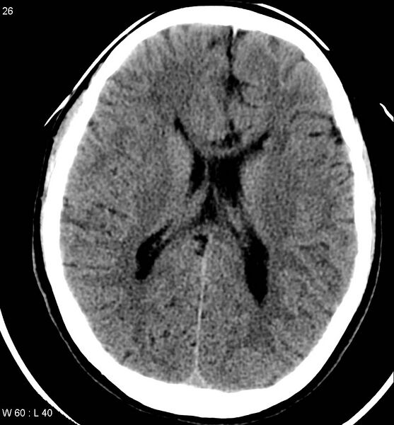 File:Aicardi syndrome (Radiopaedia 5353-7116 Axial non-contrast 23).jpg