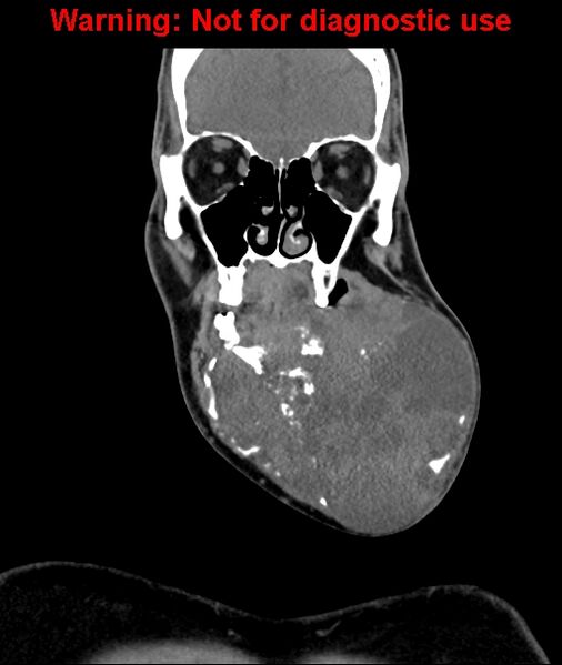 File:Ameloblastoma (Radiopaedia 33126-34164 D 23).jpg