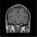 Amnestic syndrome secondary to hypoxic brain injury (Radiopaedia 24743-25004 B 13).jpg