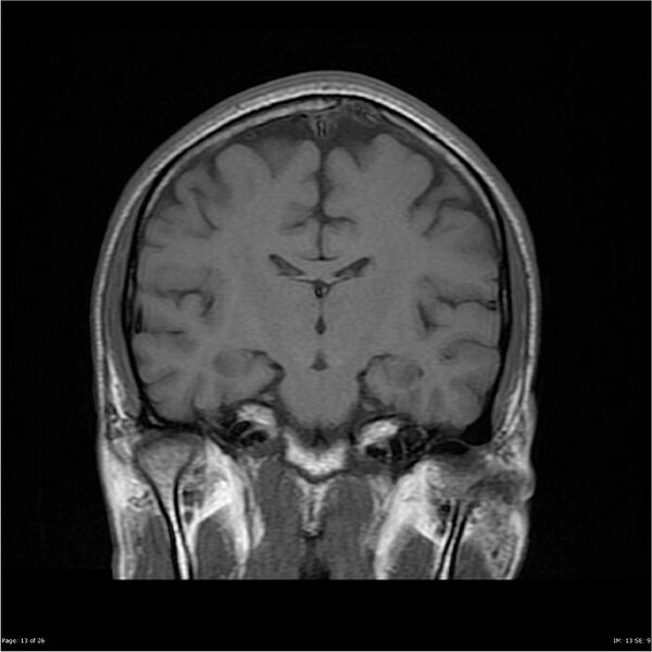 File:Amnestic syndrome secondary to hypoxic brain injury (Radiopaedia 24743-25004 B 13).jpg