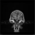 Amnestic syndrome secondary to hypoxic brain injury (Radiopaedia 24743-25004 B 25).jpg