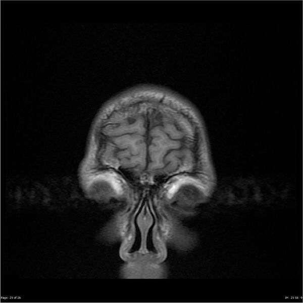 File:Amnestic syndrome secondary to hypoxic brain injury (Radiopaedia 24743-25004 B 25).jpg