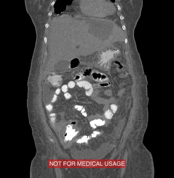 File:Amoebic enterocolitis with liver abscess (Radiopaedia 35100-36609 B 45).jpg