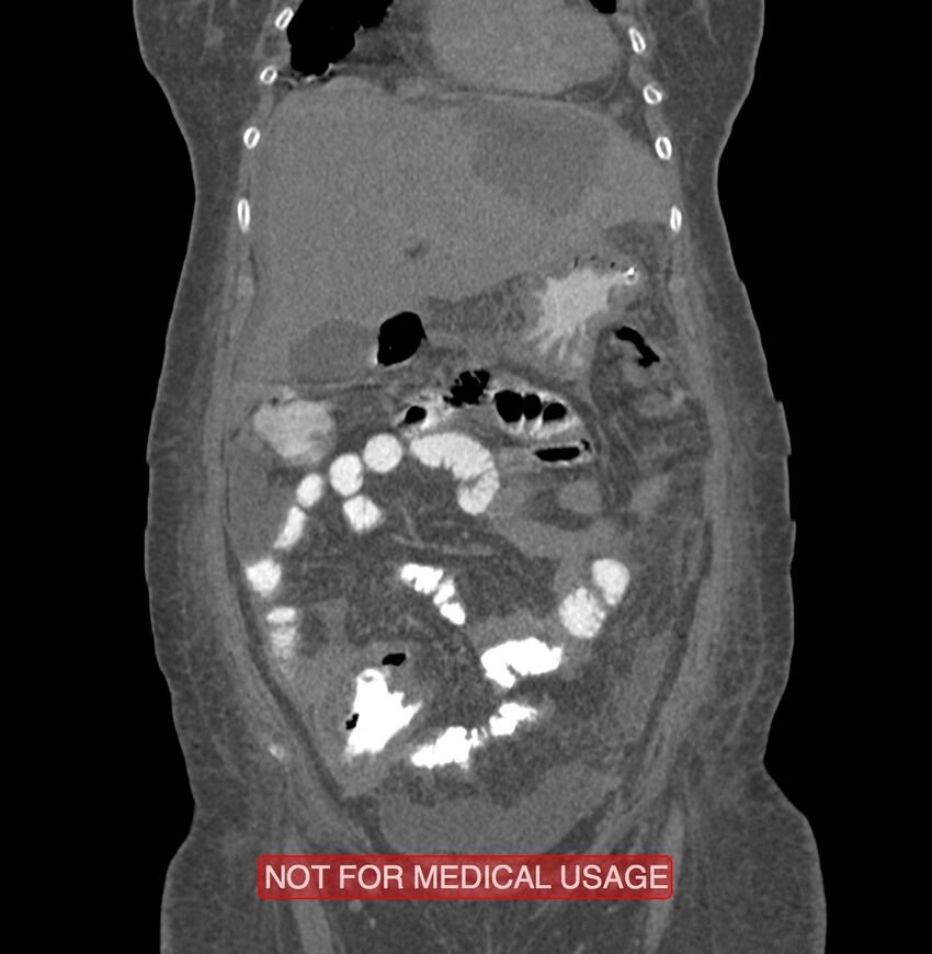 Amoebic enterocolitis with liver abscess (Radiopaedia 35100-36609 B 45).jpg
