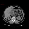 Ampullary carcinoma (Radiopaedia 56396-63056 Axial non-contrast 19).jpg